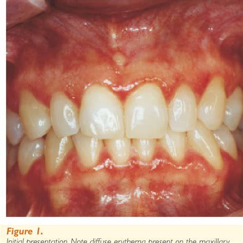 virbagen|chronic ulcerative paradental stomatitis.